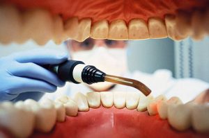art3-Batch#7747-kw3- implantes dentales en bilbao