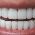 Reparación de dientes con tetraciclina